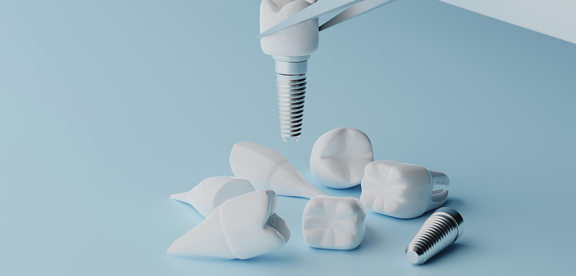How Long Is the Implant Life?