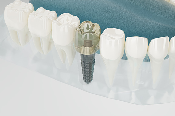 Focus Dental Clinic İmplant Diş Tedavileri Focus Dental Clinic İmplant Diş Tedavileri
