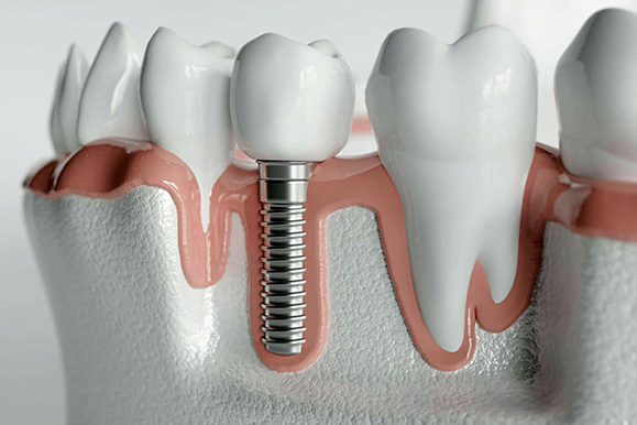 Focus Dental Clinic İmplant Diş Tedavileri Focus Dental Clinic İmplant Diş Tedavileri