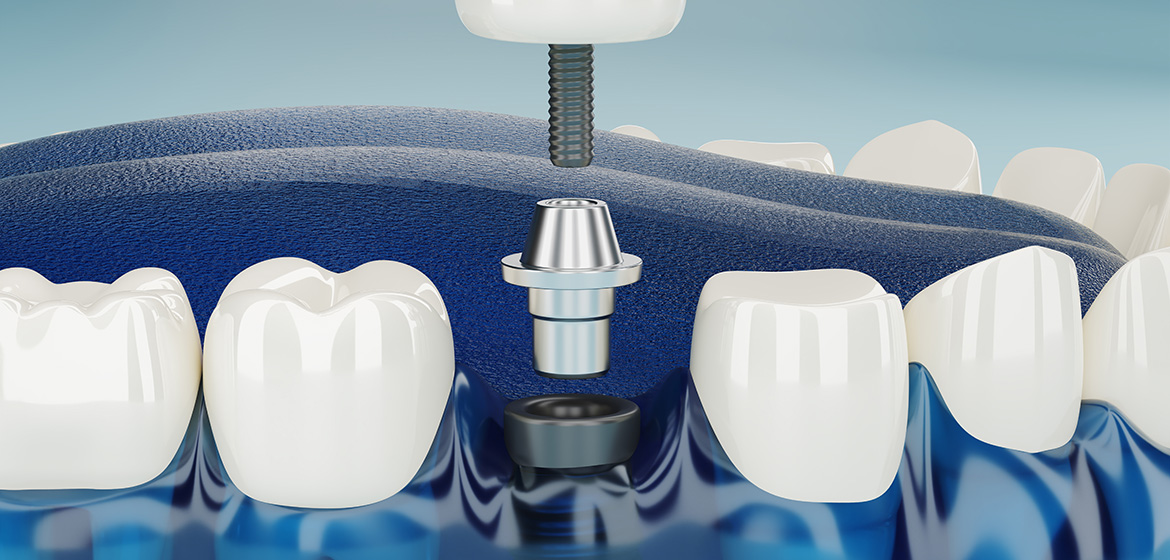 Implant Treatment in Diabetes