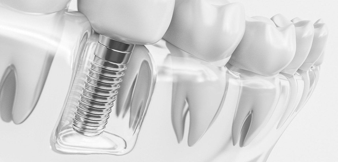 Implant Treatment in Smokers