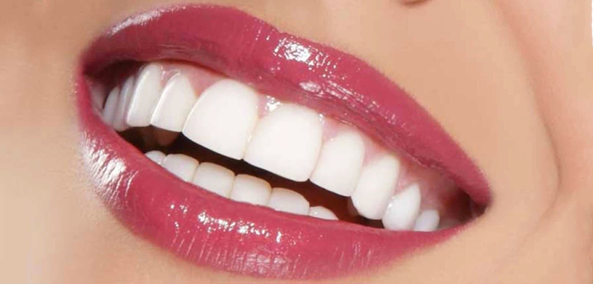 Hollywood Smile Nedir? Kimlere Yapılır?